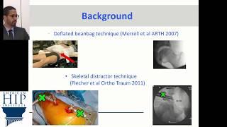 Perineal Pressure During Hip Arthroscopy is Reduced by Introduction of Trendelenburg Positioning