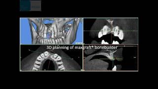 maxgraft® bonebuilder technology – customized allogenic bone block