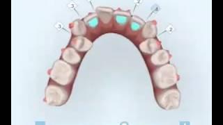 不拔牙矯正過程(隱適美隱形牙套)