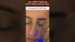 Face lift or skin tightening by BTL exillis at skinaa clinic #facelift #skintightening #skinaaclinic