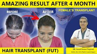 Amazing Result of Hair Transplant after 4 month | FUT-Female Hair Transplant | in Kolkata