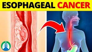 Top 10 Early Warning Signs of Esophageal Cancer | NEVER Ignore THIS