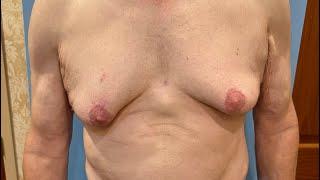 LEBO GYNO/BEYOND CALIFORNIA MALE (60) VASER HI-DEF "NECK 2 NUTS" LIPO, RENUVION & GLAND REMOVAL,