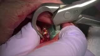 Physics Forceps Extraction of Decayed Roots on Lower Mouth 2 from GoldenDent, Atraumatic Extraction