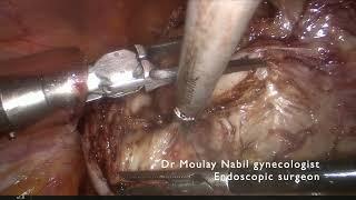 Difficult myomectomy after using GnRh analog