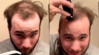 BALDING YOUNG - Dealing With Going Bald, ED  & Hair loss Insecurities By Shaving My Head