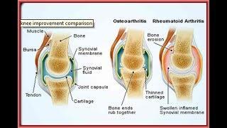 Joint  Supplement Relief For  Pain In Knees | Joint Advance -Over Counter