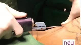 Power-Assisted Liposuction (PAL) in slow motion