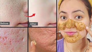 7 Days Challenge : Get Rid of *OPEN PORES, LARGE PORES, CLOGGED PORES* Permanently in 7 Days