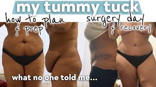 What I Wish I Knew Before Getting A Tummy Tuck (full abdominoplasty)