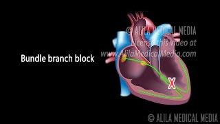 Types of Heart Blocks, Narrated Animation Part 1