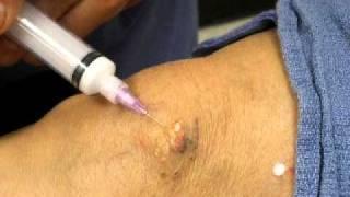 Buffalo Niagara Sclerotherapy Part IV - Dr. Karamanoukian
