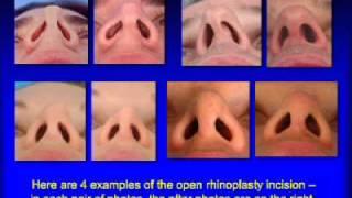 Open Versus Closed Rhinoplasty by Rhinoplasty Specialist Dr. Becker in New Jersey