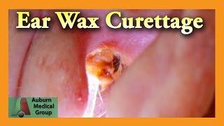 Ear Wax Removal of a Full Ear | Auburn Medical Group