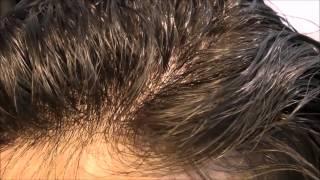 SOLUZIONE CADUTA CAPELLI, rimedio perdita capelli, calvizie, sfoltimento, alopecia, CASERTA NAPOLI