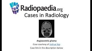 Angiocentric glioma (Radiopaedia.org) Cases in Radiology