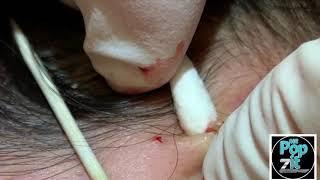 Your new favorite extraction video part 1. Blackheads, whiteheads, milia. Over 20 minutes of pops.