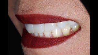 Video Procedure of Placing Dental Veneers with Dental Implant at Cosmetic Dental Associates