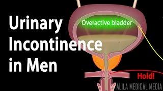 Urinary Incontinence in Men, Animation