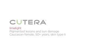 Xeo Limelight by Cutera - Skin Rejuvenation - Advanced Esthetics