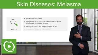 Skin Diseases: Melasma (Chloasma) – Pathology | Lecturio