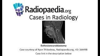 Esthesioneuroblastoma (Radiopaedia.org) Cases in Radiology