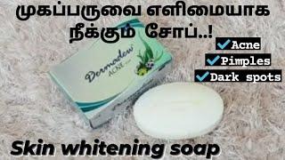 dermadew soap review| dermadew acne soap review in tamil| Best skin whitening soap