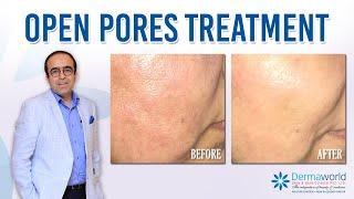 Get rid of Scars, Marks and Open Pores| Dr Rohit Batra