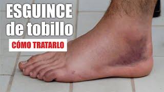 ESGUINCE o TORCEDURA de TOBILLO  Tratamiento De Rotura De LIGAMENTOS De Tobillo ⭐ Dr EDSON SERRANO