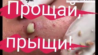 удаление прыщей №23 Unbelievable Transformation: Watch THIS to See How to Get Rid of Acne!