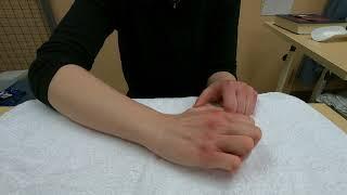 Hand injury exercise 6: Active big knuckle straightening