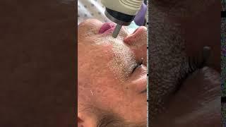 Fractional CO2 Laser Resurfacing