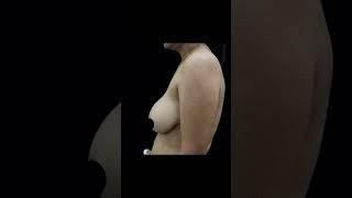 Astonishing Results Of Breast Reduction | Handa Aesthetics #shortsfeed #shorts