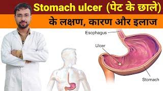 पेट के अल्सर के लक्षण, कारण और इलाज | Stomach Ulcer Causes, Symptoms & Treatment | Diet For Ulcer