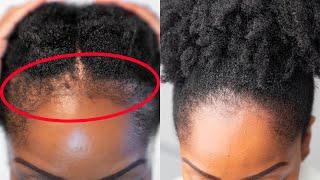 GROW Back Your EDGES FASTER with these 5 SIMPLE Tips!