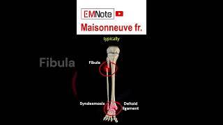 Maisonneuve Fracture