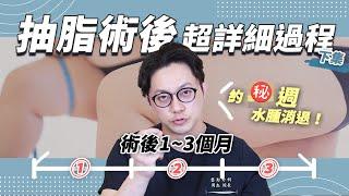 大腿抽脂術後必經歷程-下 大腿好麻正常嗎？塑身衣到底多重要？｜周杰醫師