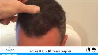 Implante Capilar con Tecnica FUE | Capilea México