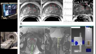 UCSF Radiology: Treatment of Prostate Cancer