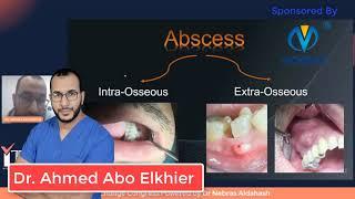 Management of Acute periapical Abcess part 1