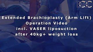 Revealed: Extended Brachioplasty with Dr. Beldholm - Transform Your Arms after Major Weight Loss