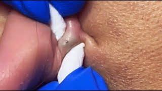 TOP OF BLACKHEADS REMOVAL FROM THE EAR  #relaxing  #blackheads