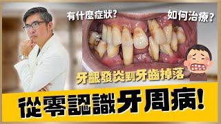 牙周病完整大解析，從零認識牙周病！牙齦發炎、腫痛、牙縫變大到牙齒掉落，從4大階段自我檢視牙周病的程度與治療方法｜【祐民牙醫－隱適美旗艦店】鑽石級楊大為醫師 #牙周病 #刷牙 #洗牙 #水雷射 #拔牙