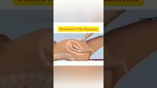 Removal Of The Placenta.......During Child Birth