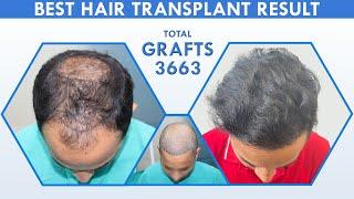 Best hair transplant result in Gurugram | Hair transplant before and after | By Dr.Santpal Sangwan