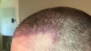 Day10 FUE - Hasson and Wong Hair Transplant Repair