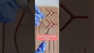 Horizontal mattress suture technique