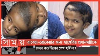 ৪৮ বার অপারেশন শেষে বাড়ি গেলো 'জোড়ামাথার' রাবেয়া-রোকেয়া ! | Conjoined Twins | Somoy TV