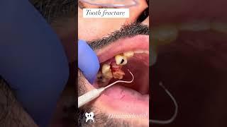 Tooth fracture