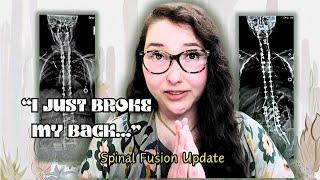 My Entire Spine Collapsed - Spinal Fusion Update